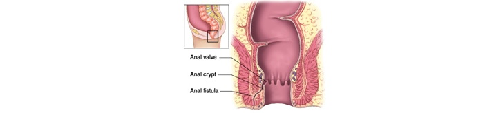 Anal Fistula